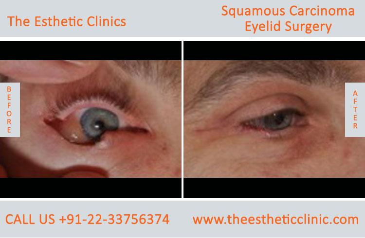 Sebaceous Carcinoma of Eyelid Surgery before after photos in mumbai india (2)